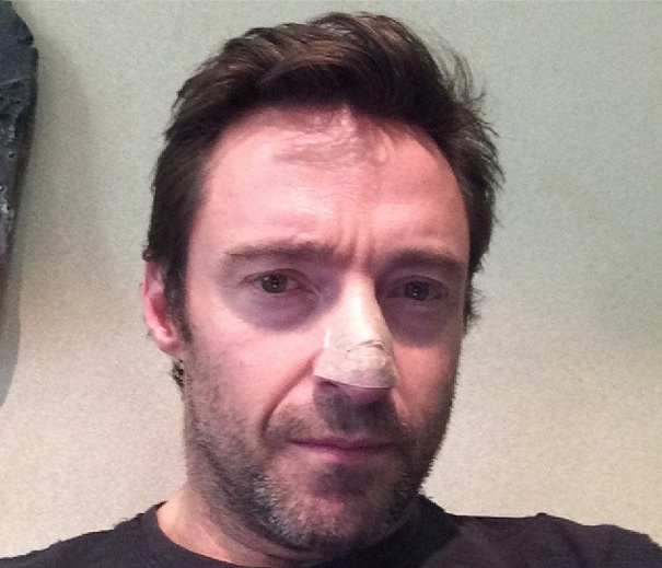 hugh jackman skin cancer