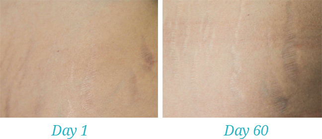 stretch mark cream results