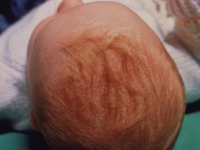 Cradle cap treatment older child cheap