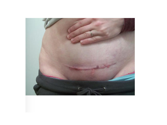 C-Section scar photo, shortly after childbirth