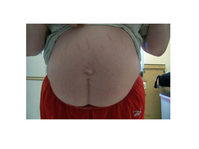 C-Section scar picture, a year after childbirth