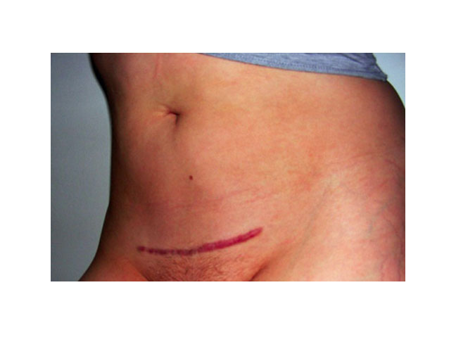 C-Section scar photo, five years post-childbirth