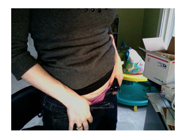 C-Section scar photo, seven months after childbirth