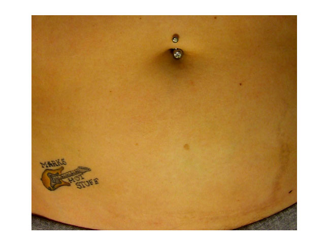 C-Section scar photo; scar is barely visible