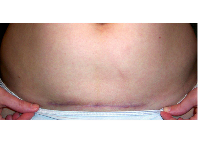 C-Section scar picture, five months postpartum