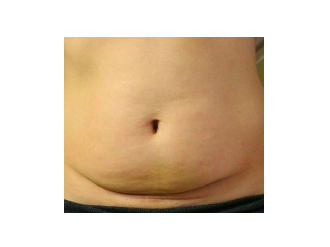 C-Section scar photo and post C-Section tummy