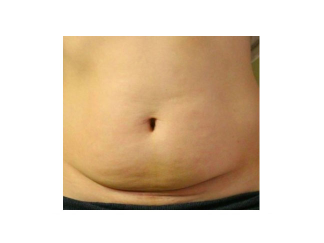 C-Section scar photo and post C-Section tummy
