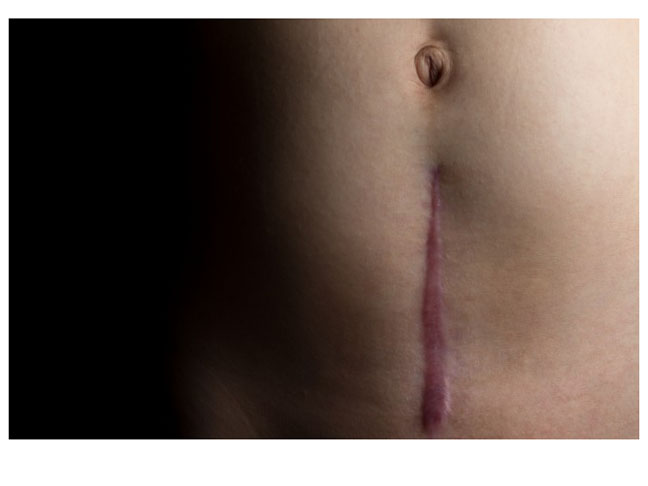 Vertical, strawberry colored C-Section scar picture