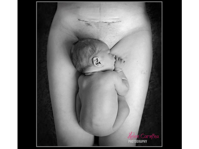 C-Section scar photo, with newborn baby