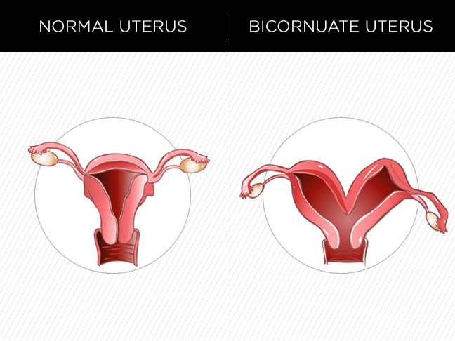 bicornuate_uterus