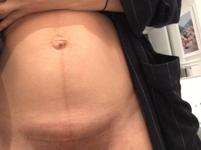C-Section Scar Picture