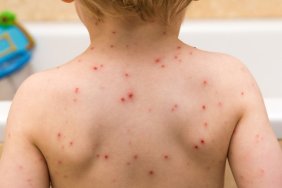 Types of Rashes: Chickpox