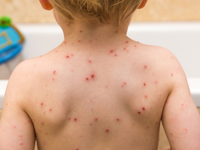 Types of Rashes: Chickpox