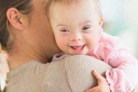 Birth Defects - Down Syndrome