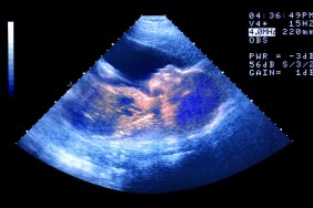 ultrasounds