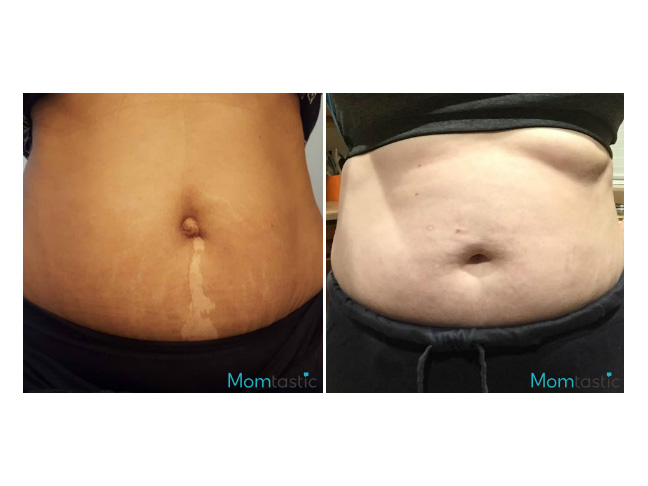 Moms Reveal What Their Bellies Look Like #1