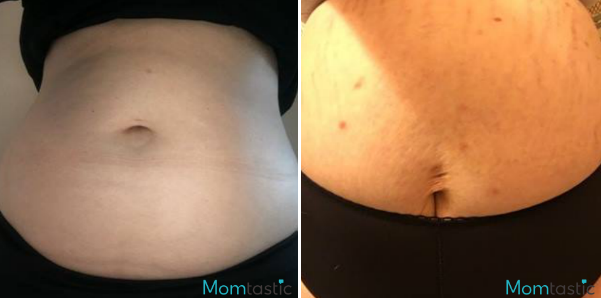 Moms Reveal What Their Bellies Look Like #10
